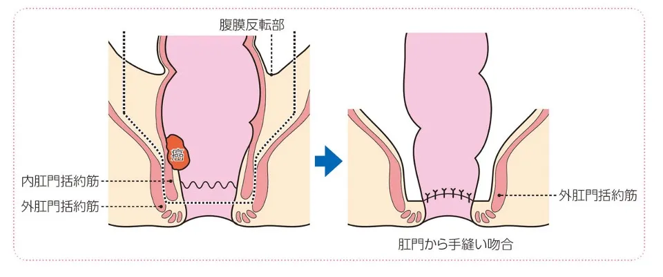 括約筋間直腸切除術