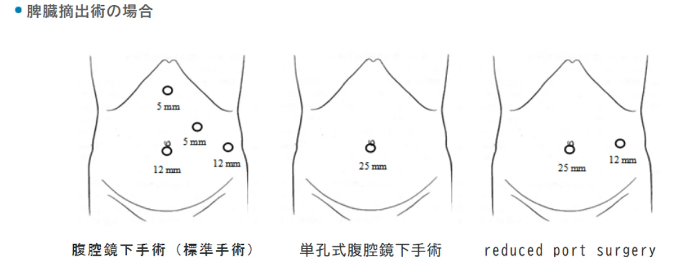 腹腔鏡下手術