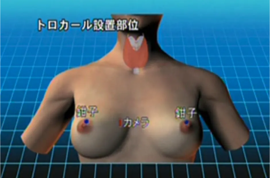 手術手技について
