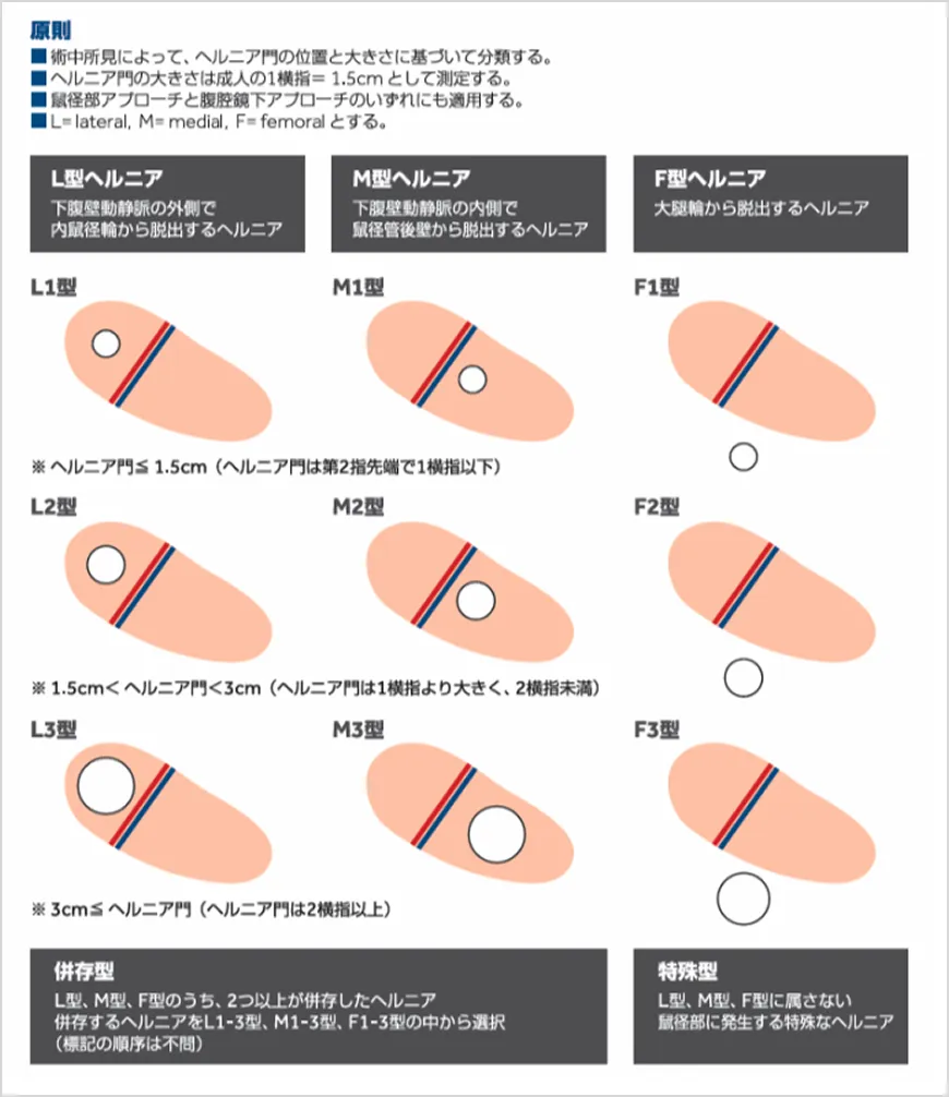 鼠径ヘルニアの種類