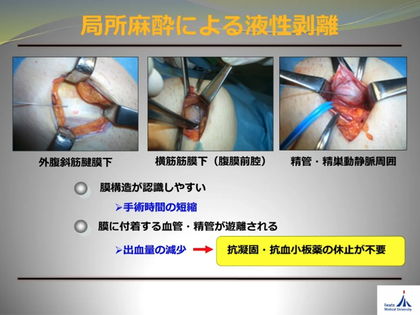 局所麻酔による液性剥離