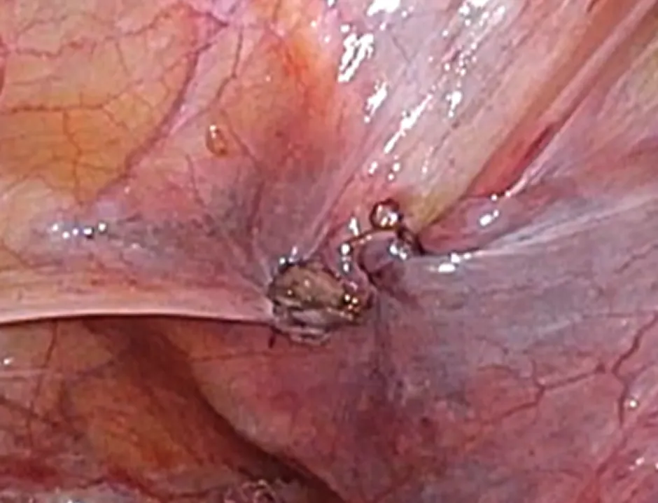 腹膜閉鎖