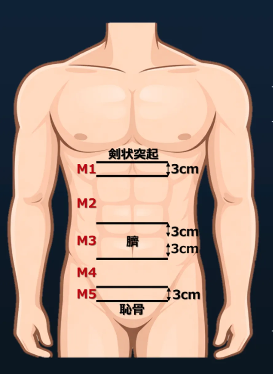 腹壁（瘢痕）ヘルニアのEHS分類