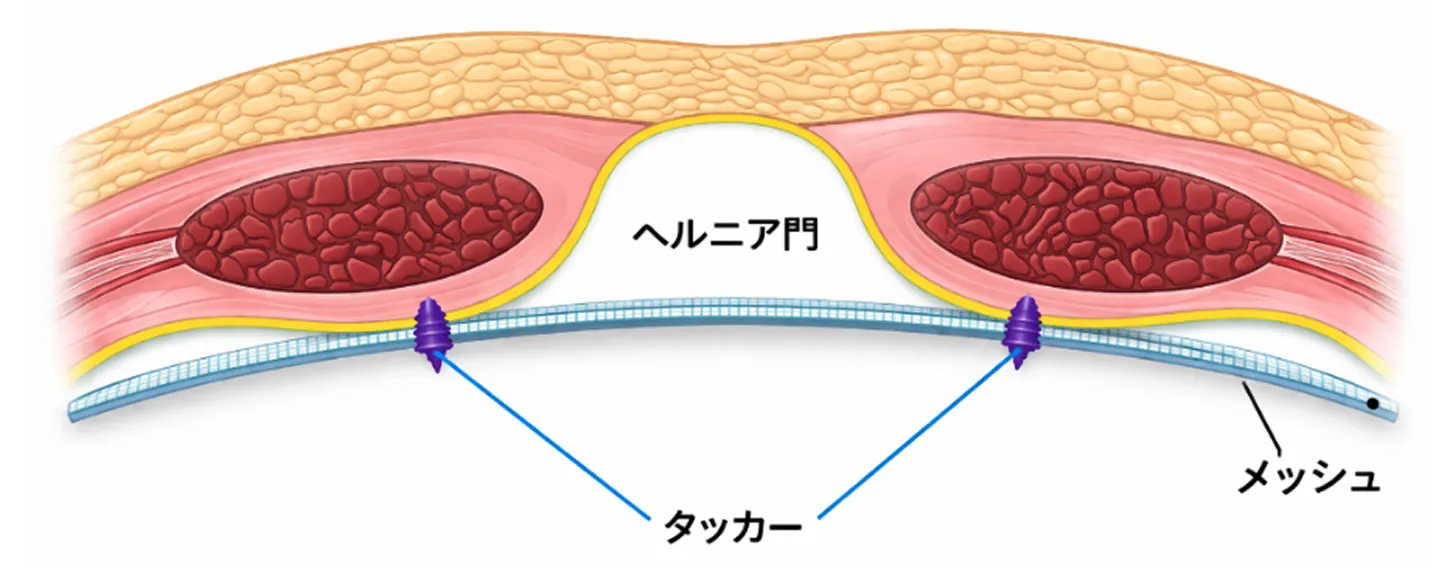 IPOM法・IPOM plus法