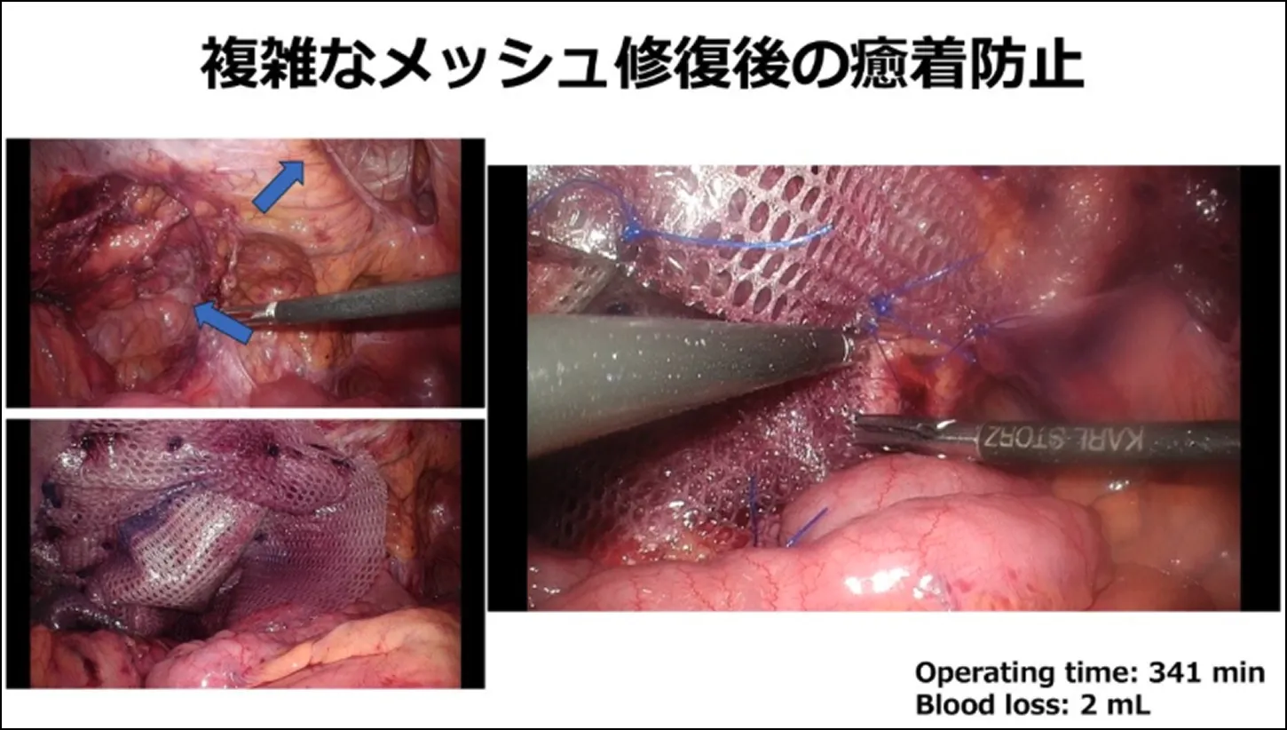 複雑なメッシュ修復後の癒着防止