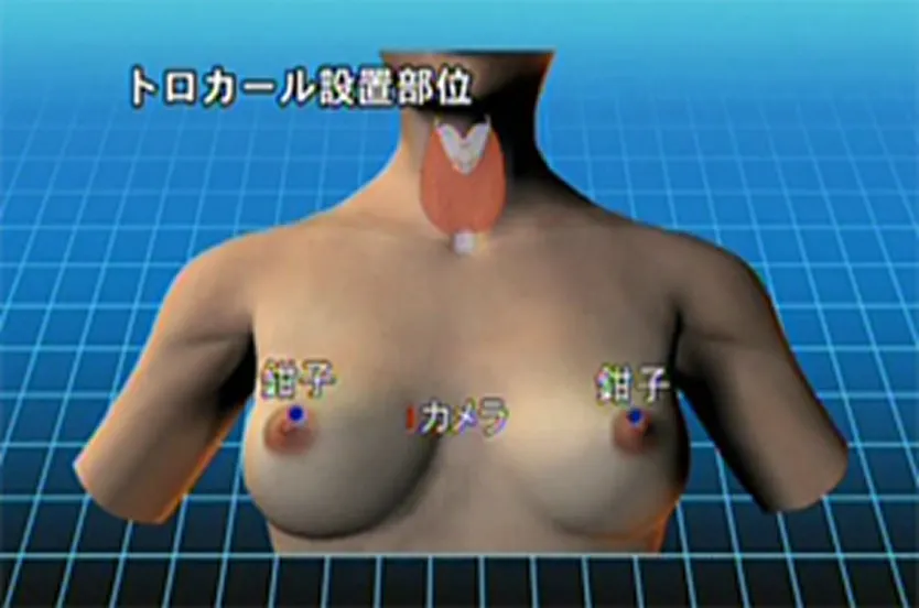 甲状腺良性疾患に対する内視鏡下甲状腺切除術