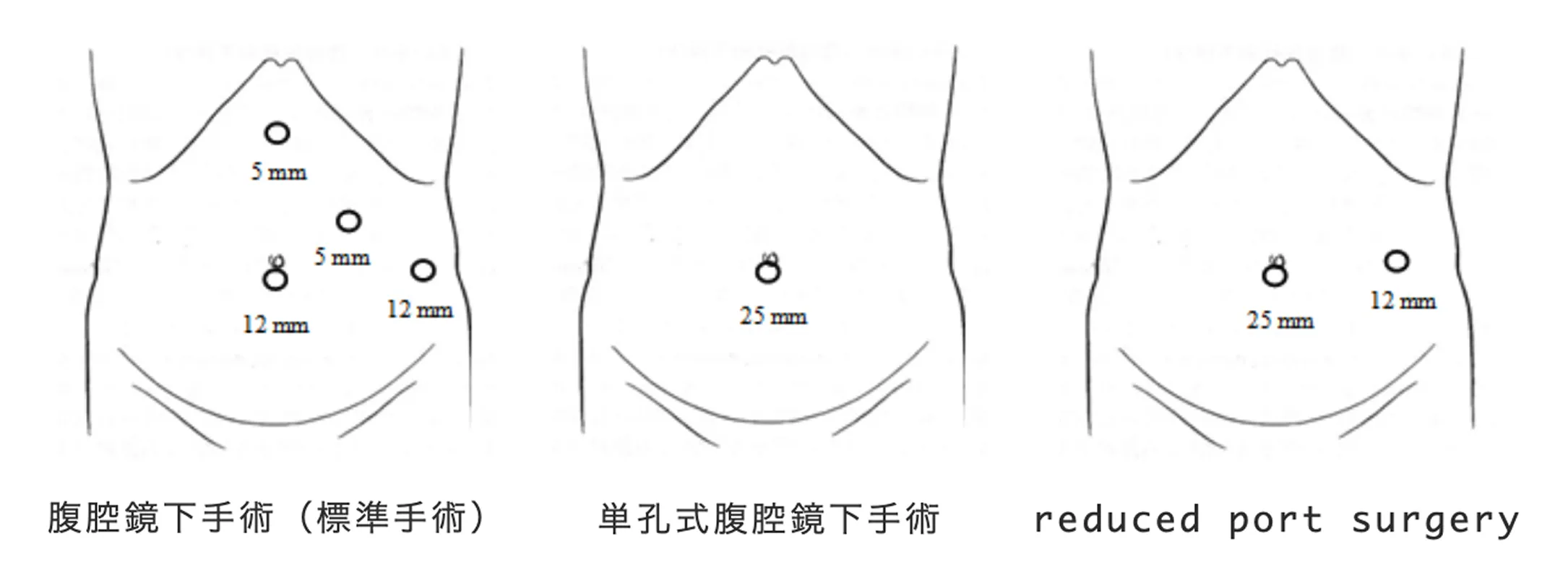 脾臓摘出術の場合