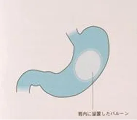 内視鏡下胃内バルーン留置術