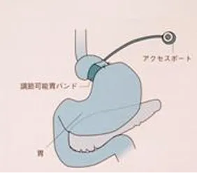 腹腔鏡下調節性胃バンディング術
