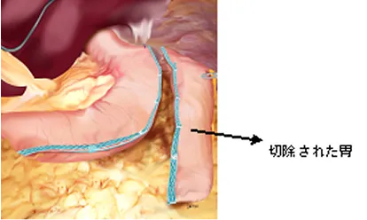 腹腔鏡下スリーブ状胃切除術