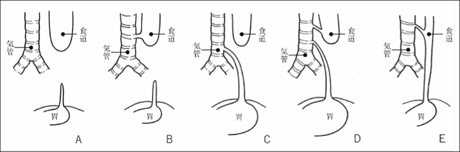 胸腔鏡下先天性食道閉鎖症手術
